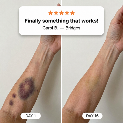 💥100K+ SOLD💕- 𝐏𝐮𝐫𝐞𝐥𝐨𝐫𝐚® Bruise Repair & Skin-Strengthening Cream
