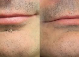 🍀Made in AU•💯 180-Day Guarantee---Purelora®2-in-1 Microneedle & Hydrocolloid Patch| Removes Raised Moles, Acne, Flat Warts & Skin Tags | Helps Improve Wrinkles, Scars & Blemishes | Invisible Patches for Face & Body
