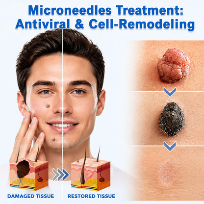 🍀Made in AU•💯 180-Day Guarantee---Purelora®2-in-1 Microneedle & Hydrocolloid Patch| Removes Raised Moles, Acne, Flat Warts & Skin Tags | Helps Improve Wrinkles, Scars & Blemishes | Invisible Patches for Face & Body