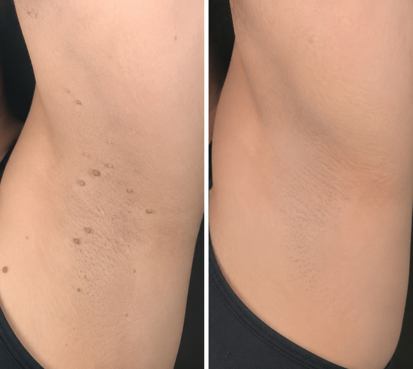 🍀Made in AU•💯 180-Day Guarantee---Purelora®2-in-1 Microneedle & Hydrocolloid Patch| Removes Raised Moles, Acne, Flat Warts & Skin Tags | Helps Improve Wrinkles, Scars & Blemishes | Invisible Patches for Face & Body