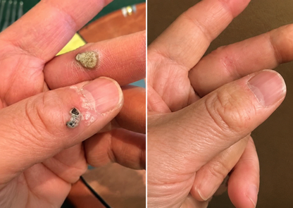 🍀Made in AU•💯 180-Day Guarantee---Purelora®2-in-1 Microneedle & Hydrocolloid Patch| Removes Raised Moles, Acne, Flat Warts & Skin Tags | Helps Improve Wrinkles, Scars & Blemishes | Invisible Patches for Face & Body